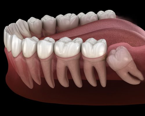 Wisdom-Teeth-Removal