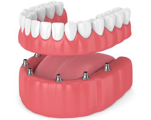dentalimplantsvsdentures