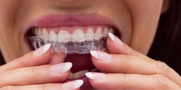 female-patient-wearing-braces