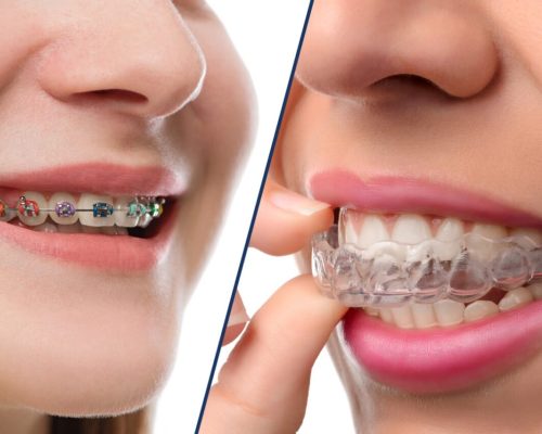 invisalign-or-braces