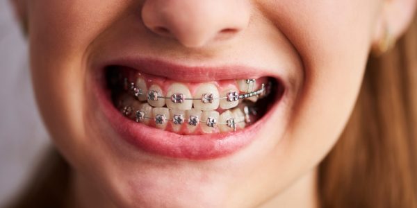 shot-teeth-with-braces