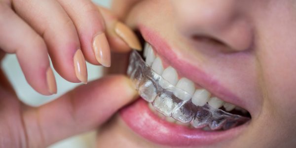 woman-wearing-orthodontic-silicone-invisible-braces